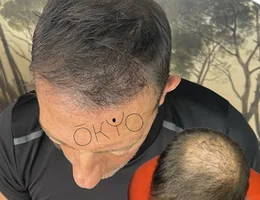 Okyo Dermopigmentation