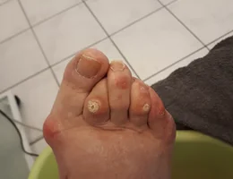 Pescura Medische Pedicure