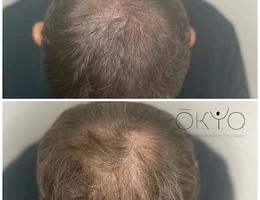 Okyo Dermopigmentation